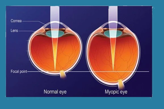 diagram showing difference between normal eye focusing light on retina and myopic eye focusing light in front of retina